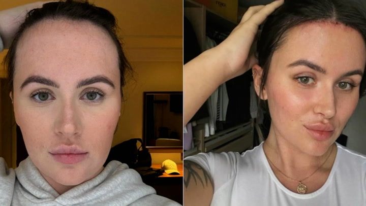 Woman who spent 9,000 getting forehead reduction shows off results | Lifestyle [Video]
